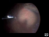 Vitrectomy and Endolaser in Near the Ora in Phakic Patients