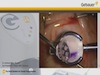 DSAEK Corneal Transplant Surgery