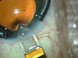Surgical Technique for IOL Exchange
