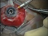 Combined Glaucoma, Vitreoretinal, and Keratoprosthesis Surgery: Pearls for a Successful Patient Outcome