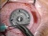 Femtosecond Laser-Assisted Penetrating Keratoplasty