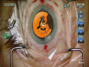 Combined Cataract and MIGS