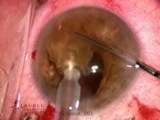 Essential Surgical Techniques for Vitrectomy