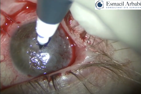 Symblepharon Dissection and Ocular Surface Reconstruction With Complex Cataract Extraction