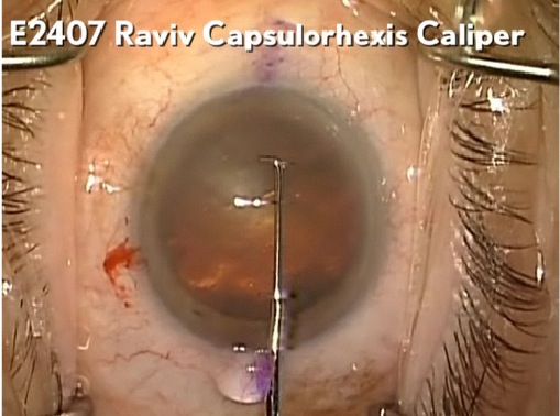 Raviv Capsulorhexis Caliper