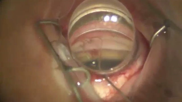 Microinvasive Glaucoma Surgery: Targeted iStentx3 Placement