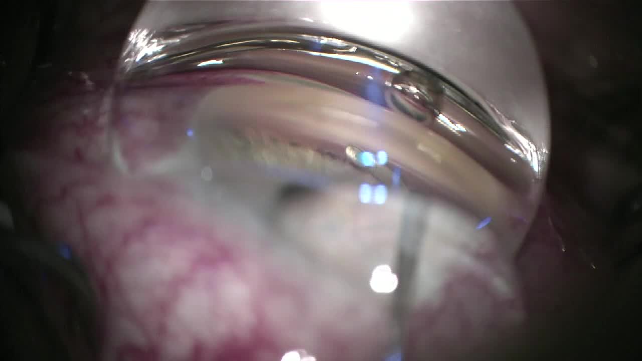 Viscodilation With Otomy Creation Using the OMNI Device