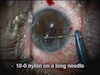 IOL Exchange and Iris Repair - Eyetube