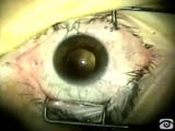 Lens and PVR sandwich with silicon oil with Co-BI-VI