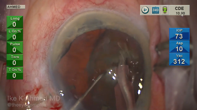 Phaco Debulk Chop for Dense Cataracts