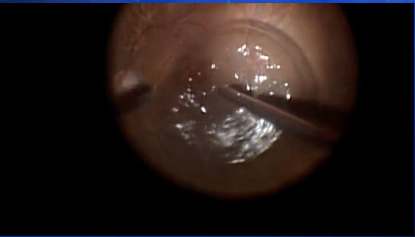 Submacular Perfluoron