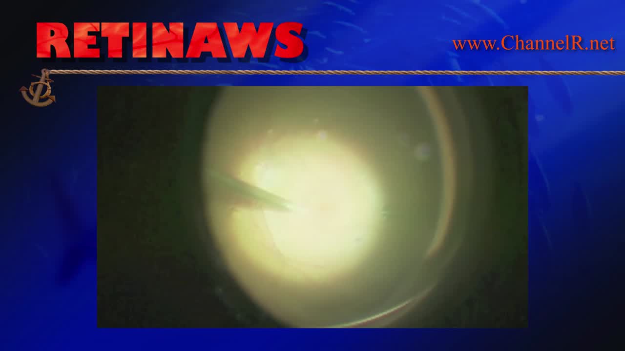 Recurrent Macular Hole