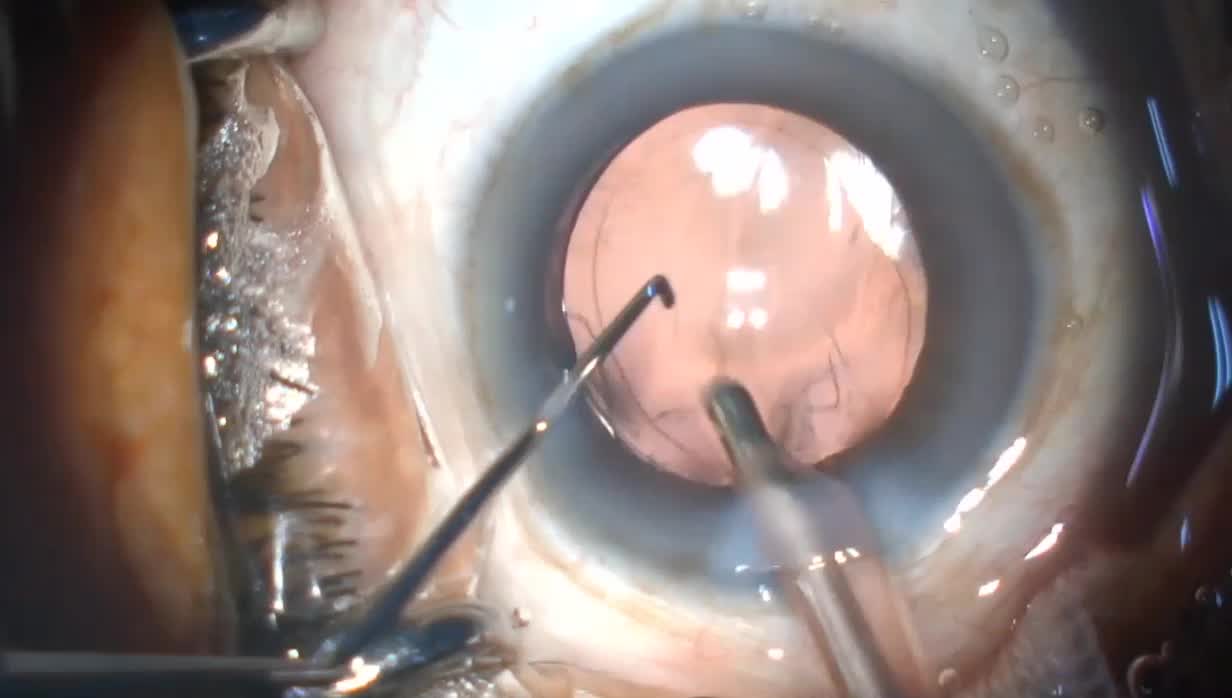 Qube Pro Phacoemulsification System Performance in Hard Cataract Removal (Case 1)