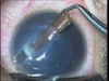 A Review of Intraocular Foreign Body Removal