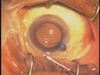 Managing Iris Prolapse at the End of Cataract Surgery 