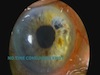 One Site Fixation for Subluxed IOLs
