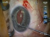 Iris Suture Fixation of a Dislocated 3-piece PCIOL