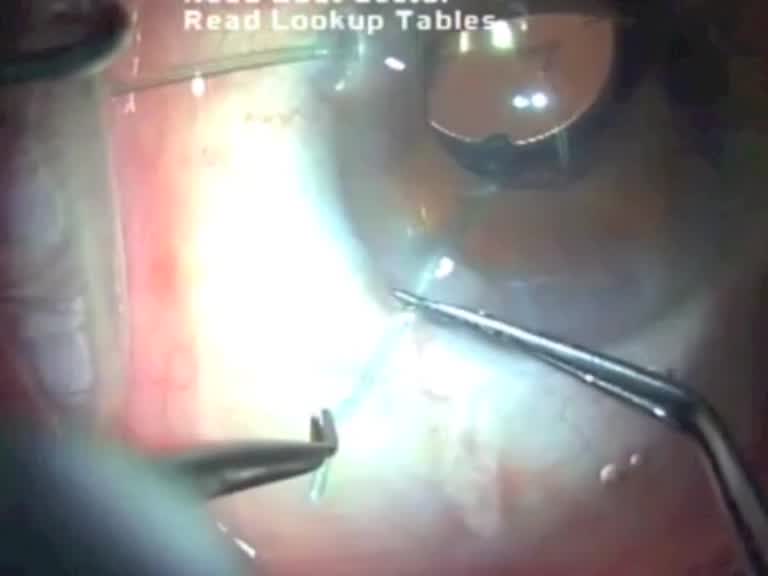 Potential Risk in Combined Use of Capsule Retractors and CTR