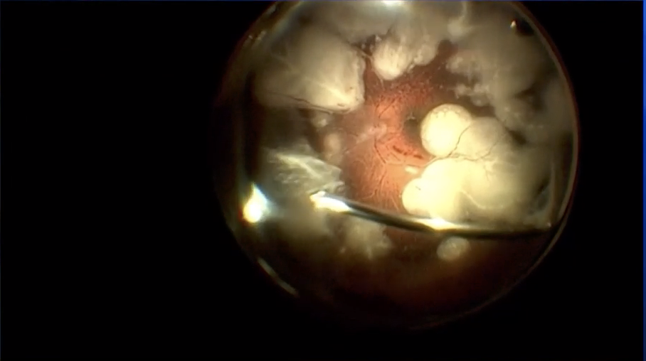 Choroidal Biopsy