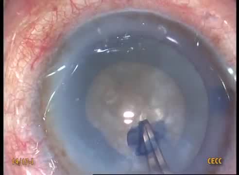 Hard Brittle Cataract