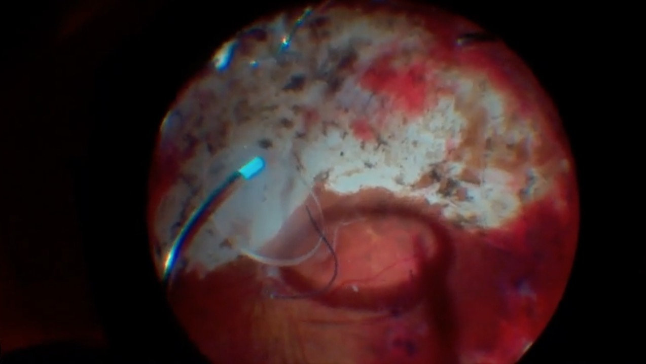 Repositioning an IOL