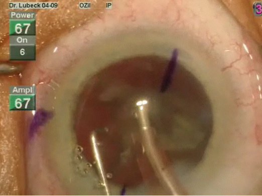 Grade 3 Cataract With Astigmatism