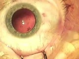 iSert Insertion Technique
