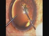 Sub 1-mm Cataract Surgery