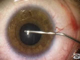 Malyugin Ring system for small pupils