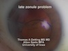 Late Zonule Problem Sutured Capsular Tension Segment