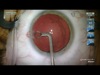 Capsule Cleansing and Primary PCCC