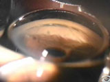 Indentation Gonioscopy with Peripheral Anterior Synechiae