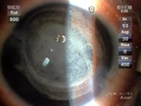 Staining the Vitreous