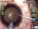 Torsional Phaco Case