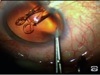 Implanting the Akreos IOL