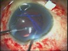 Glued Endocapsular Hemi-Ring Segments for Capsular Bag Fixation