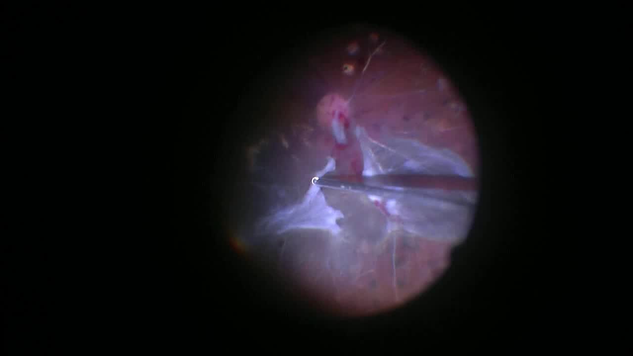 Multifunctional Use of 27-Gauge Vitreous Cutter in Combined Tractional-Rhegmatogeneous Retinal Detachment