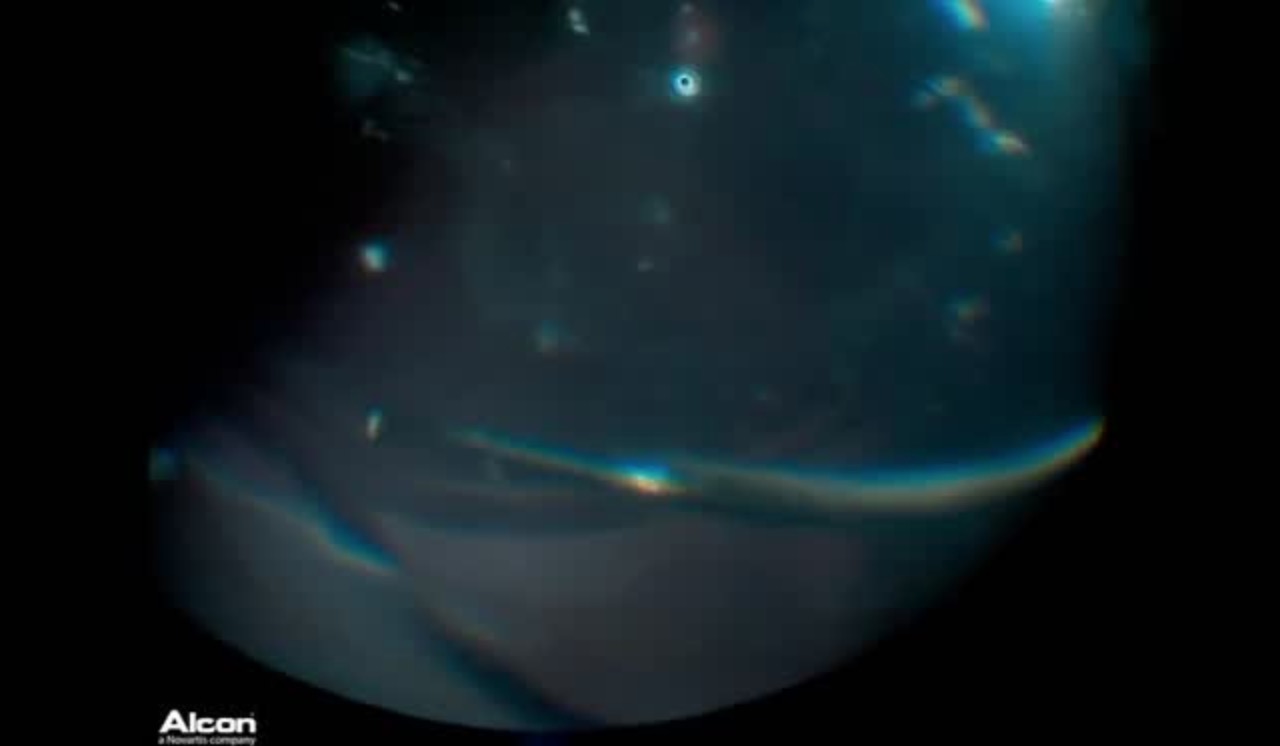 Retinal Detachment Secondary to Stickler Syndrome (Part 3)