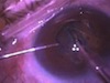 Silicone Oil Removal: The Anterior Approach