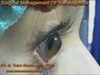 Surgical Management of Keratoglobus
