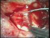 Optic Nerve Sheath Fenestration
