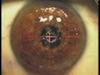t-LASEK for Granular Corneal Dystrophy