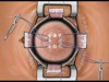 Perforated Coated Bio-eye Hydroxyapatite Orbital Implant