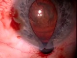 Management of Intraocular Iris Prolapse