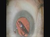 Techniques for Inserting the enVista Lens Through Different Sized Incisions Including Wound Assist