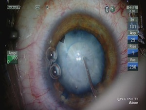 Use of Femtoscecond Technology to Treat a White Traumatic Cataract