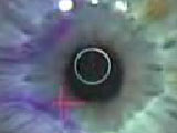 Complete Epi-LASIK with 50um Flap