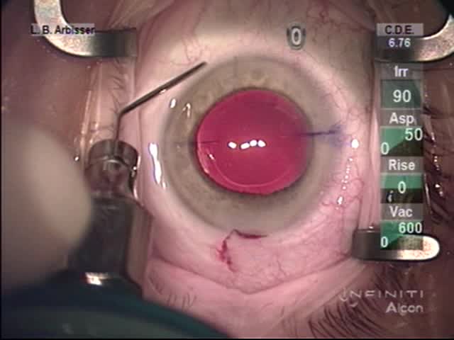 No Incision Inflow at Low IOP