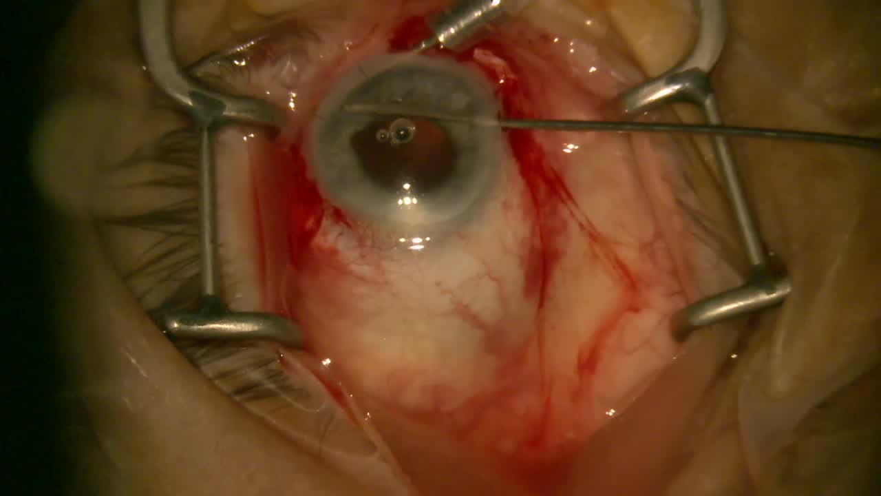 Glued IOL Nasal Approach with Reusable Infusion Line