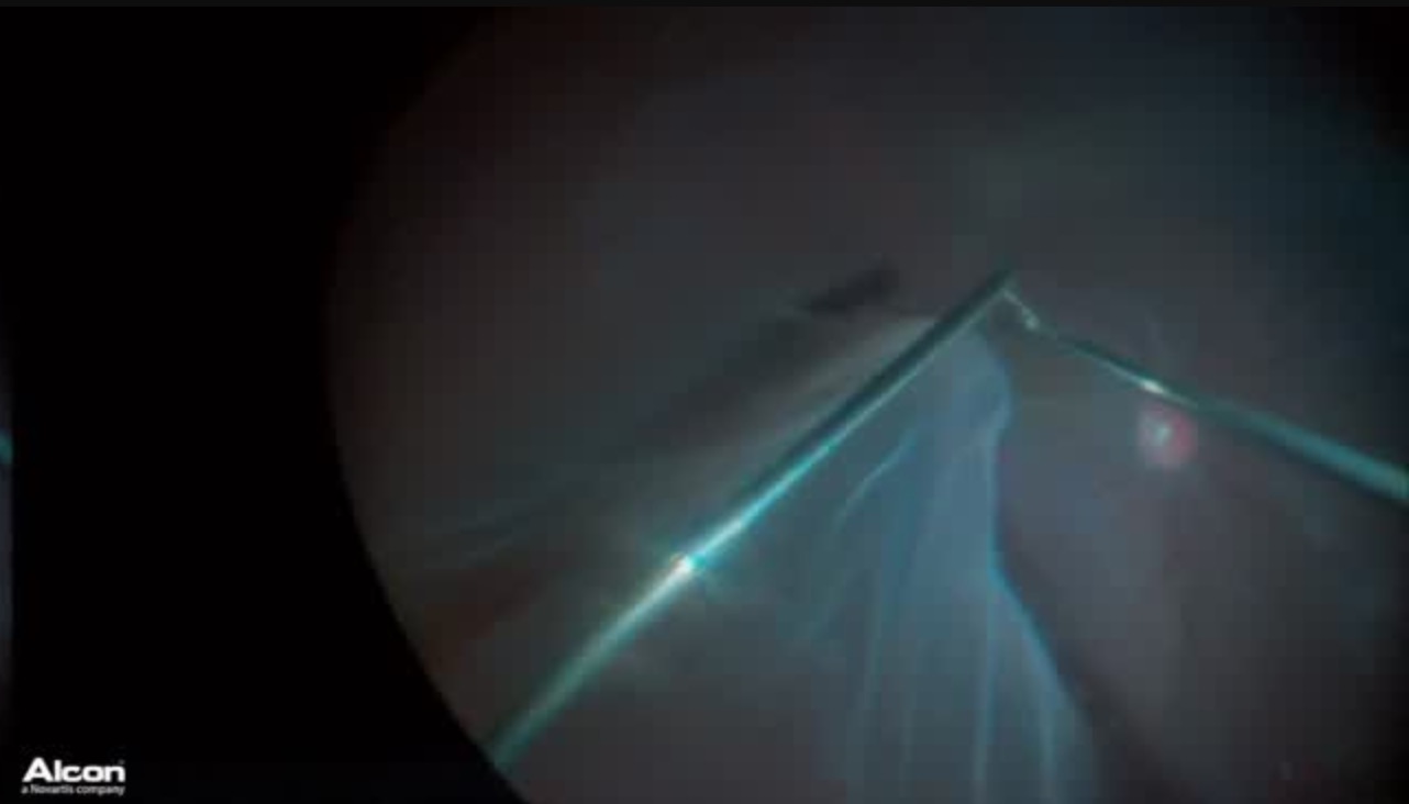 Retinal Detachment Secondary to Stickler Syndrome (Part 2)